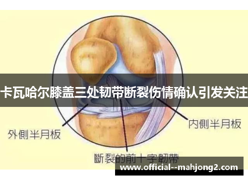 卡瓦哈尔膝盖三处韧带断裂伤情确认引发关注